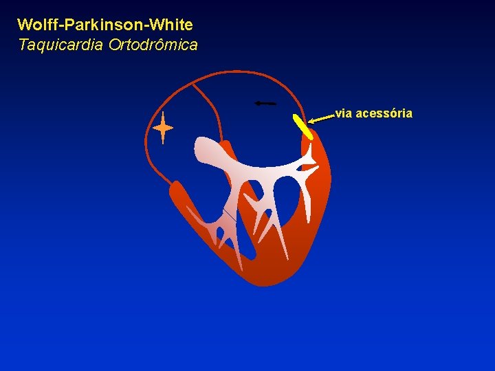 Wolff-Parkinson-White Taquicardia Ortodrômica via acessória 