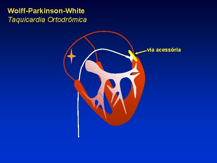 Wolff-Parkinson-White Taquicardia Ortodrômica via acessória 