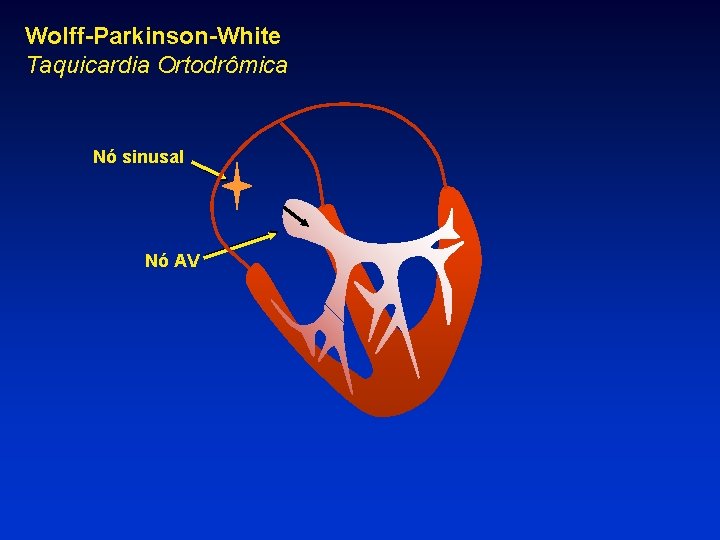 Wolff-Parkinson-White Taquicardia Ortodrômica Nó sinusal Nó AV 