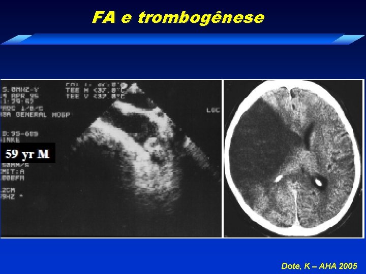 FA e trombogênese Dote, K – AHA 2005 