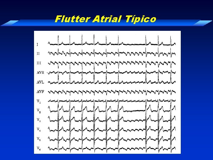 Flutter Atrial Típico 