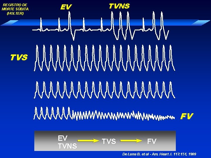 REGISTRO DE MORTE SÚBITA (HOLTER) EV TVNS TVS FV De Luna B. et al