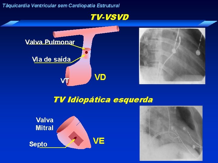 Tàquicardia Ventricular sem Cardiopatia Estrutural TV-VSVD Valva Pulmonar Via de saída VT VD TV