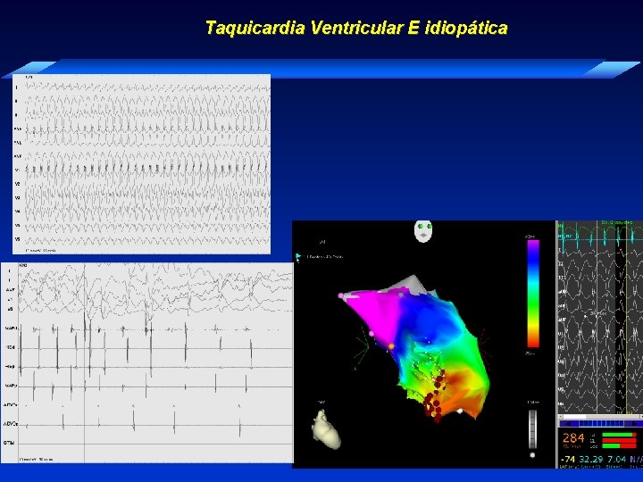 Taquicardia Ventricular E idiopática Mapeamento eletroanatômico e mapa de propagação 