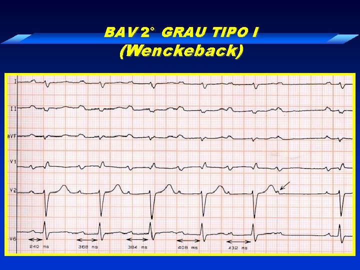 BAV 2° GRAU TIPO I (Wenckeback) 