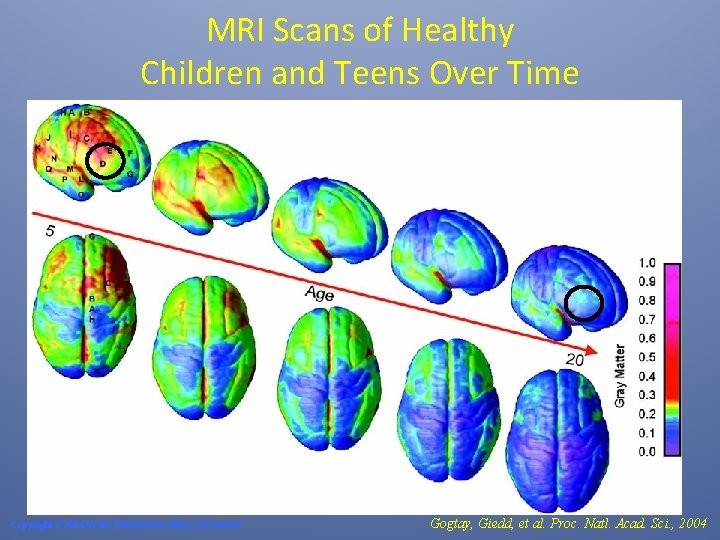 MRI Scans of Healthy Children and Teens Over Time Copyright © 2004 by the