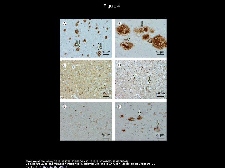 Figure 4 The Lancet Neurology 2016 151326 -1335 DOI: (10. 1016/S 1474 -4422(16)30193 -4)