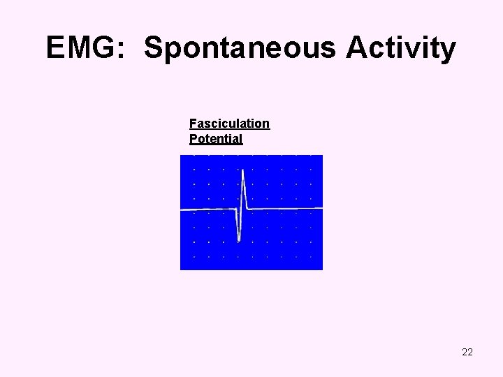 EMG: Spontaneous Activity Fasciculation Potential 22 