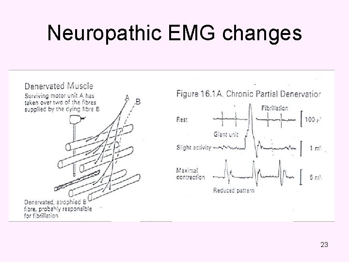 Neuropathic EMG changes 23 