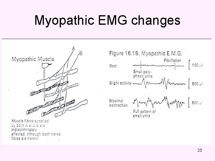 Myopathic EMG changes 25 