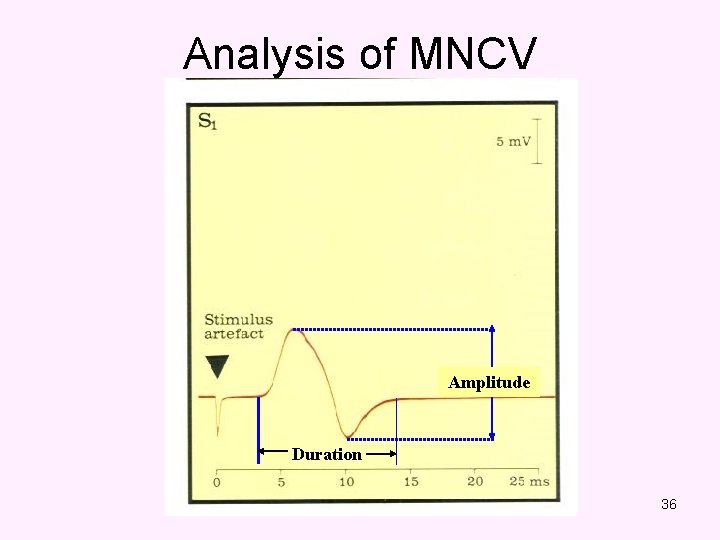 Analysis of MNCV Amplitude Duration 36 