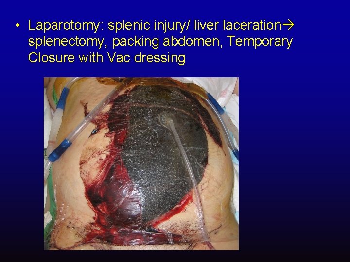  • Laparotomy: splenic injury/ liver laceration splenectomy, packing abdomen, Temporary Closure with Vac