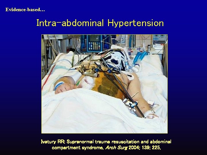 Evidence-based… Intra-abdominal Hypertension Ivatury RR: Supranormal trauma resuscitation and abdominal compartment syndrome. Arch Surg