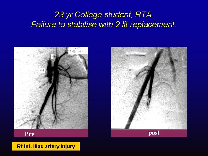 23 yr College student; RTA. Failure to stabilise with 2 lit replacement. Rt Int.