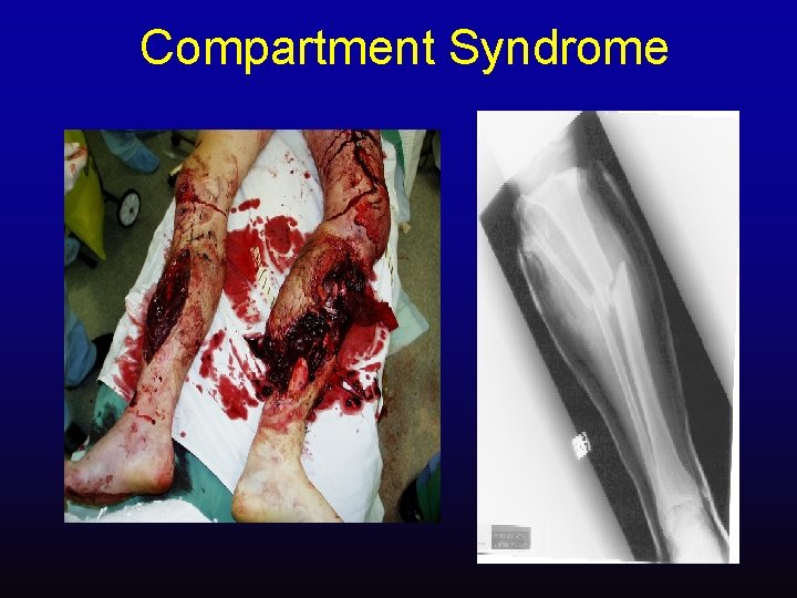 Compartment Syndrome 
