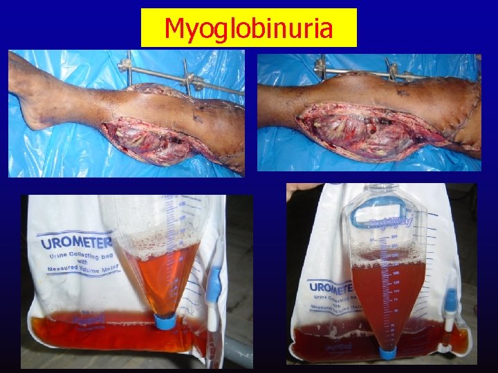 Myoglobinuria 