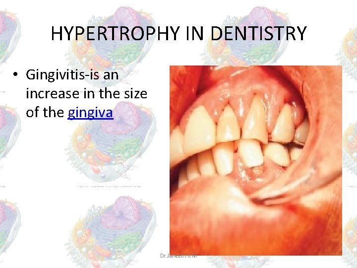 HYPERTROPHY IN DENTISTRY • Gingivitis-is an increase in the size of the gingiva Dr. HYPERTROPHY IN DENTISTRY • Gingivitis-is an increase in the size of the gingiva Dr.