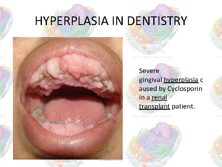 HYPERPLASIA IN DENTISTRY Severe gingival hyperplasia c aused by Cyclosporin in a renal transplant HYPERPLASIA IN DENTISTRY Severe gingival hyperplasia c aused by Cyclosporin in a renal transplant