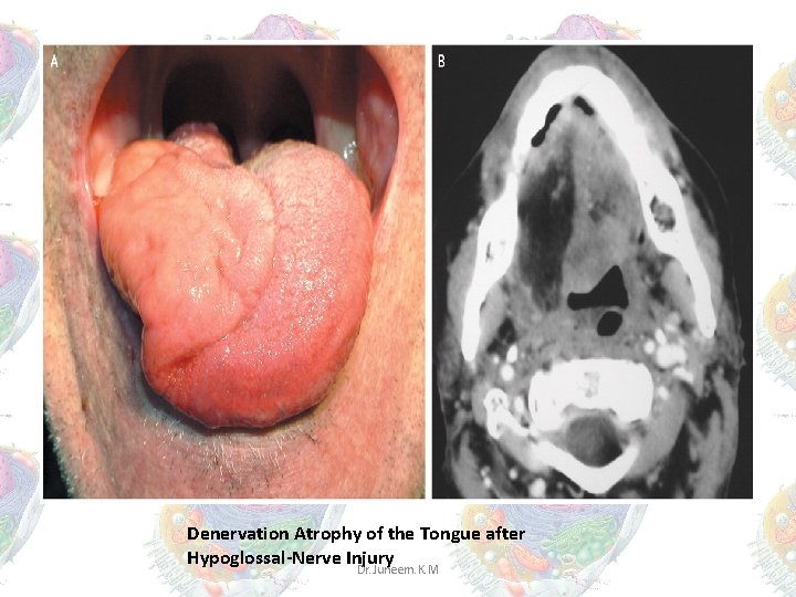 Denervation Atrophy of the Tongue after Hypoglossal-Nerve Injury Dr. Juneem. K. M Denervation Atrophy of the Tongue after Hypoglossal-Nerve Injury Dr. Juneem. K. M