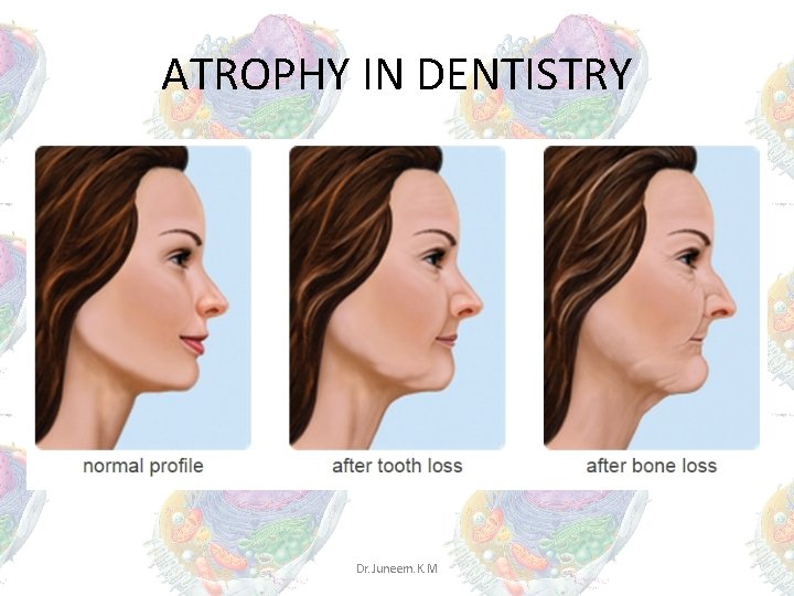 ATROPHY IN DENTISTRY Dr. Juneem. K. M ATROPHY IN DENTISTRY Dr. Juneem. K. M