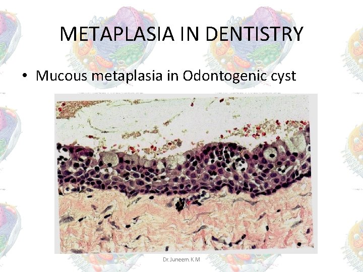 METAPLASIA IN DENTISTRY • Mucous metaplasia in Odontogenic cyst Dr. Juneem. K. M METAPLASIA IN DENTISTRY • Mucous metaplasia in Odontogenic cyst Dr. Juneem. K. M