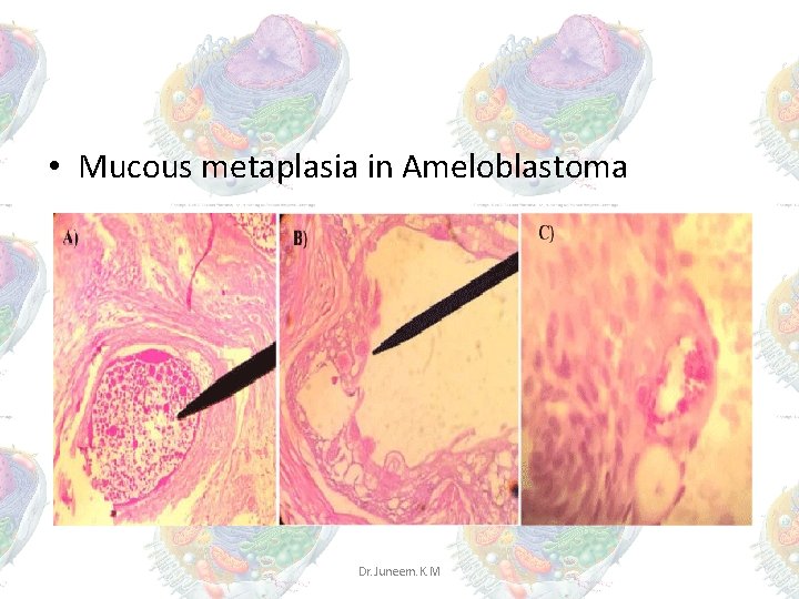 • Mucous metaplasia in Ameloblastoma Dr. Juneem. K. M • Mucous metaplasia in Ameloblastoma Dr. Juneem. K. M