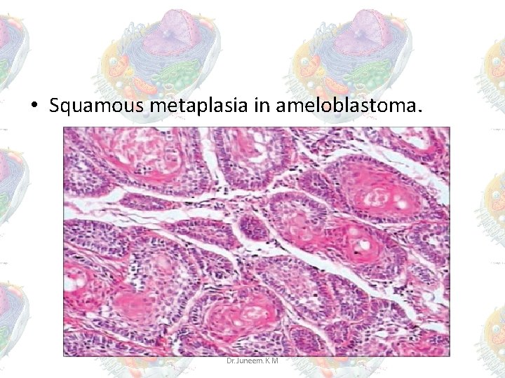 • Squamous metaplasia in ameloblastoma. Dr. Juneem. K. M • Squamous metaplasia in ameloblastoma. Dr. Juneem. K. M