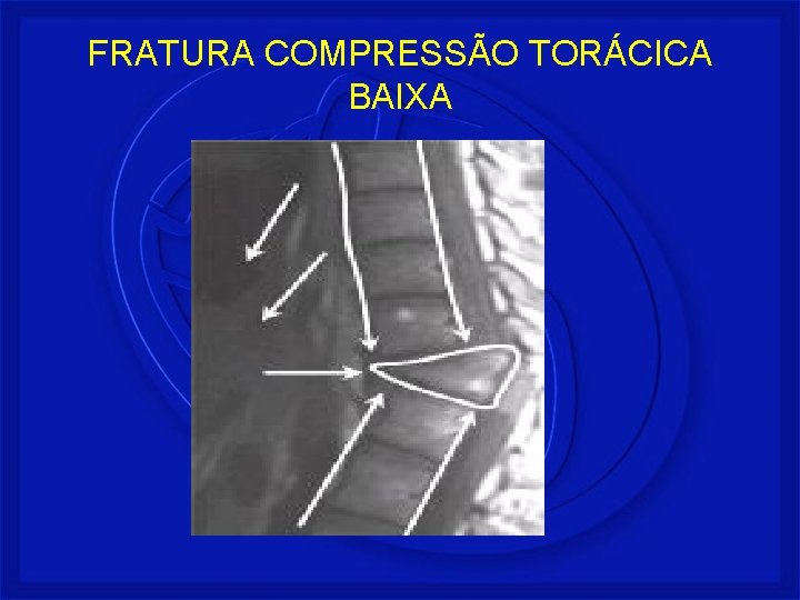 FRATURA COMPRESSÃO TORÁCICA BAIXA 