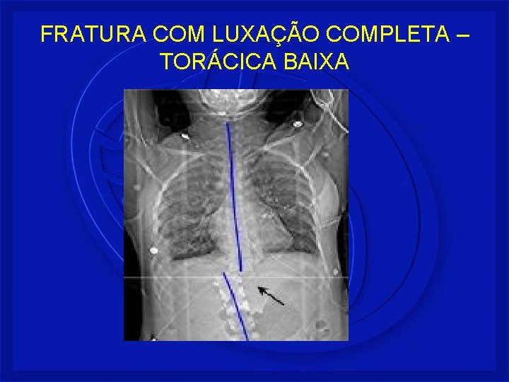 FRATURA COM LUXAÇÃO COMPLETA – TORÁCICA BAIXA 