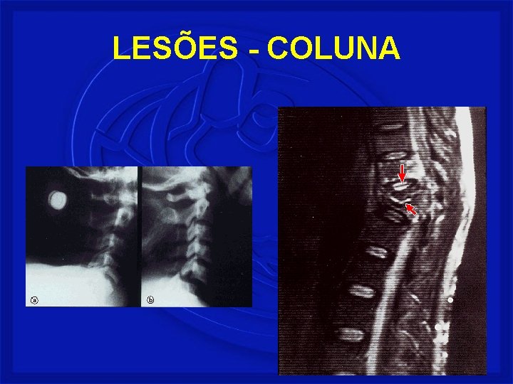 LESÕES - COLUNA 