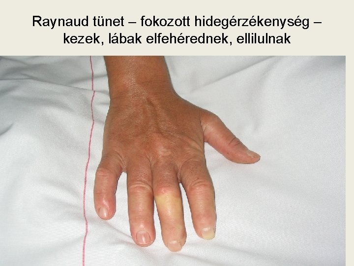 Raynaud tünet – fokozott hidegérzékenység – kezek, lábak elfehérednek, ellilulnak 