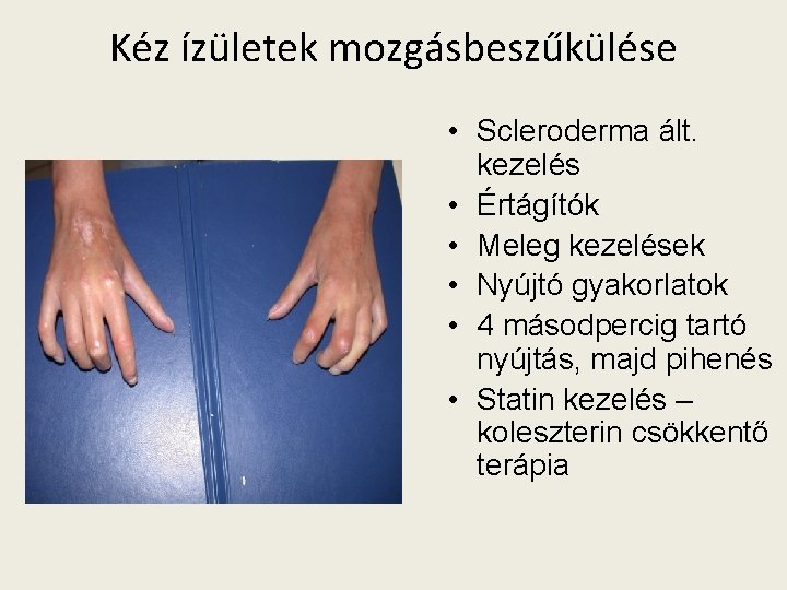 Kéz ízületek mozgásbeszűkülése • Scleroderma ált. kezelés • Értágítók • Meleg kezelések • Nyújtó
