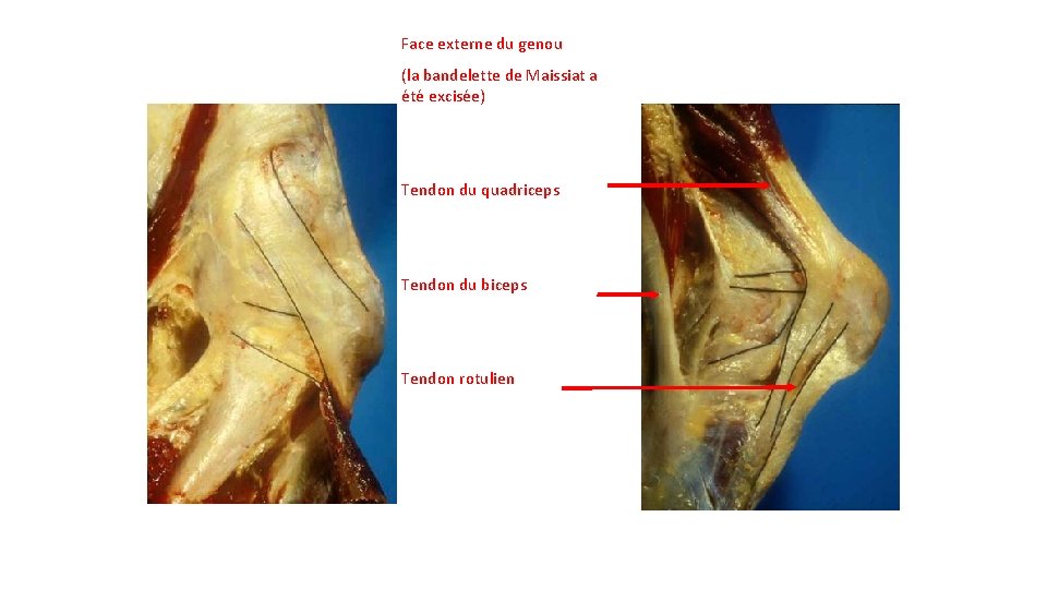 Face externe du genou (la bandelette de Maissiat a été excisée) Tendon du quadriceps