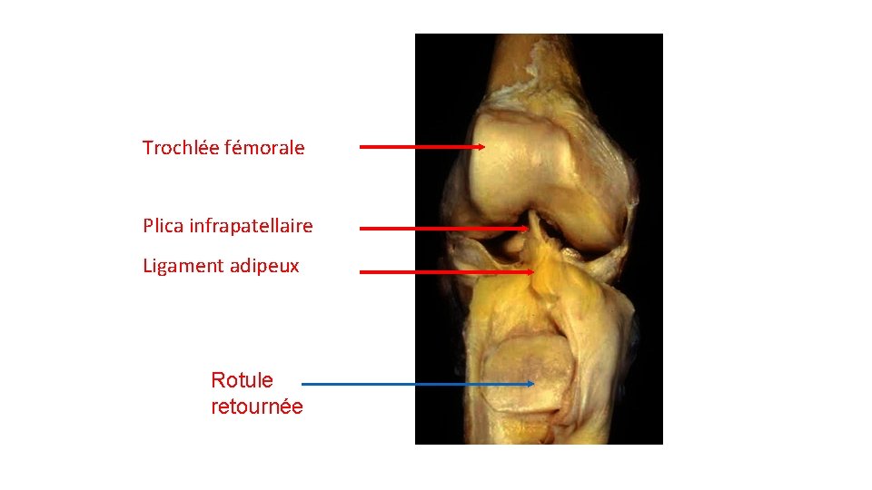 Vue antérieure Trochlée fémorale Plica infrapatellaire Ligament adipeux Rotule retournée Document F Bonnel 