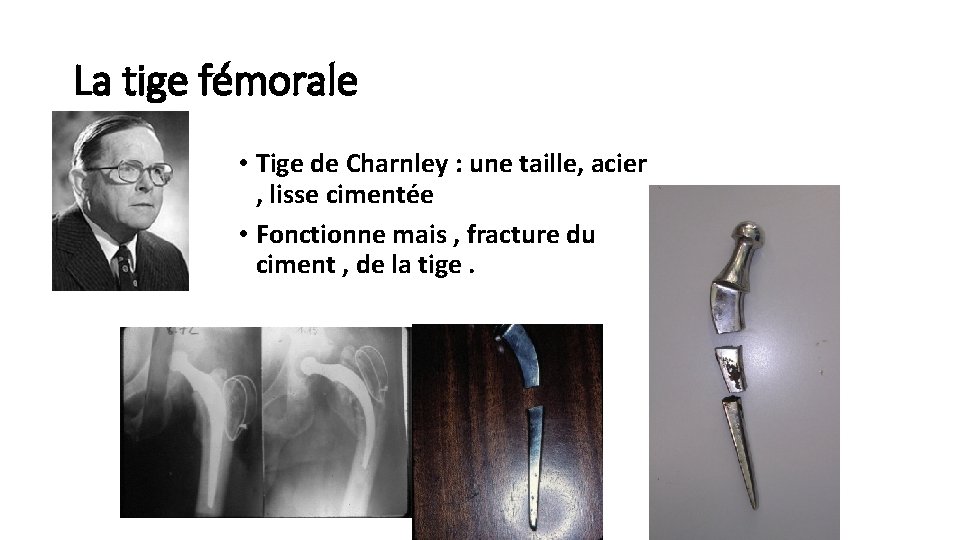 La tige fémorale • Tige de Charnley : une taille, acier , lisse cimentée