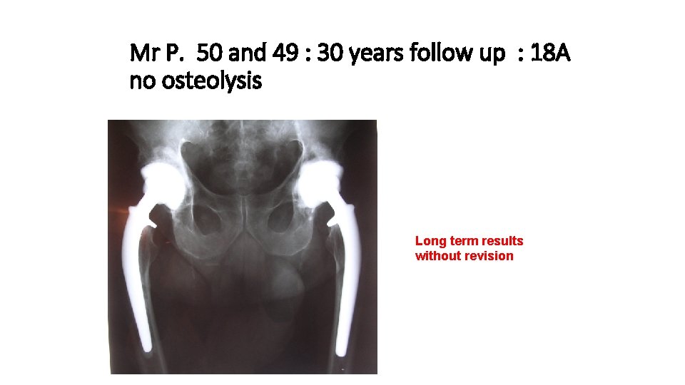 Mr P. 50 and 49 : 30 years follow up : 18 A no