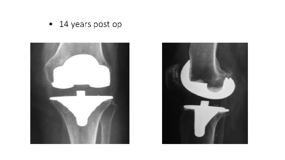  • 14 years post op 