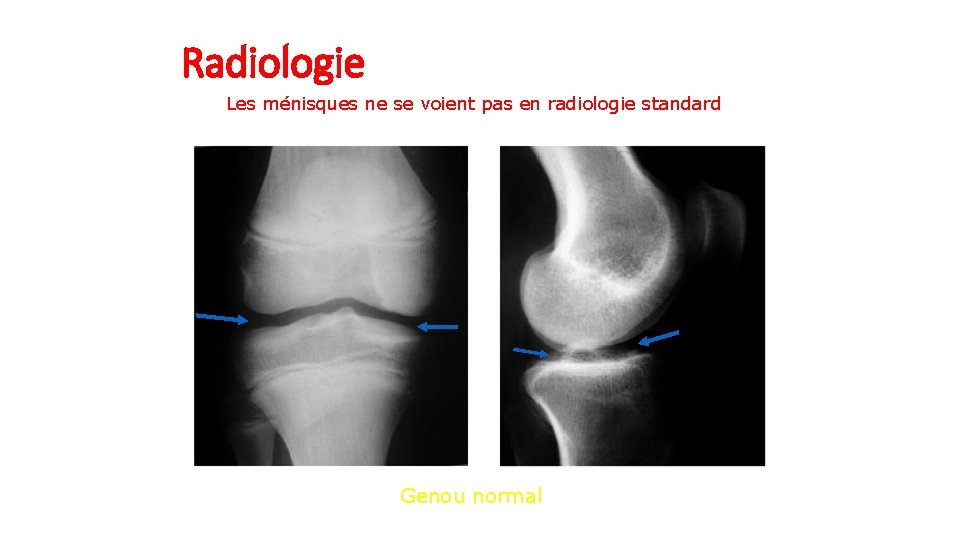 Radiologie Les ménisques ne se voient pas en radiologie standard Genou normal 