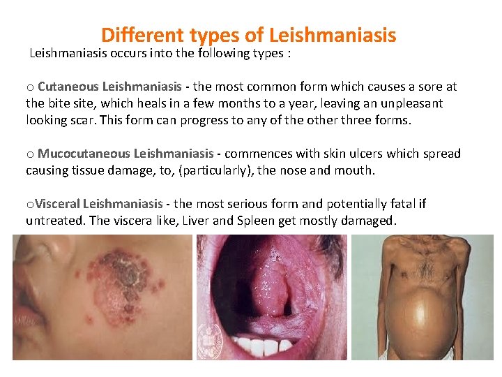 Different types of Leishmaniasis occurs into the following types : o Cutaneous Leishmaniasis -