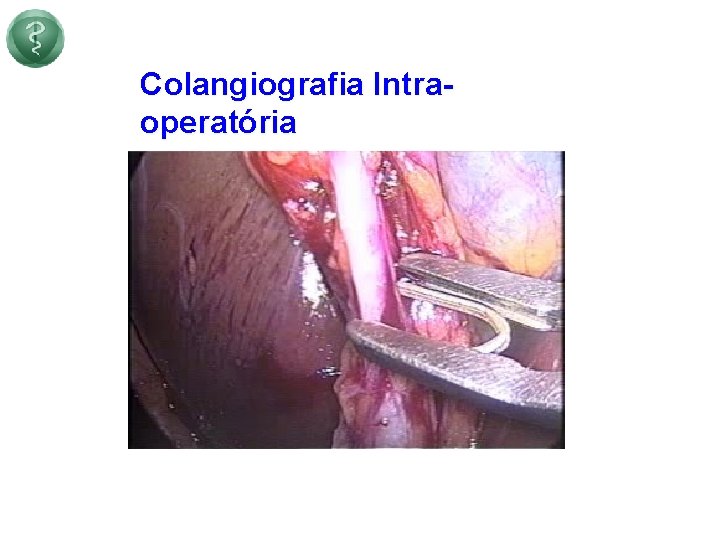 Colangiografia Intraoperatória 