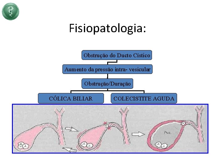 Fisiopatologia: Obstrução do Ducto Cístico Aumento da pressão intra- vesicular Obstrução/Duração CÓLICA BILIAR COLECISTITE