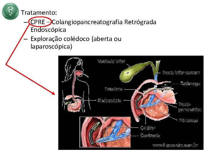  • Tratamento: – CPRE – Colangiopancreatografia Retrógrada Endoscópica – Exploração colédoco (aberta ou