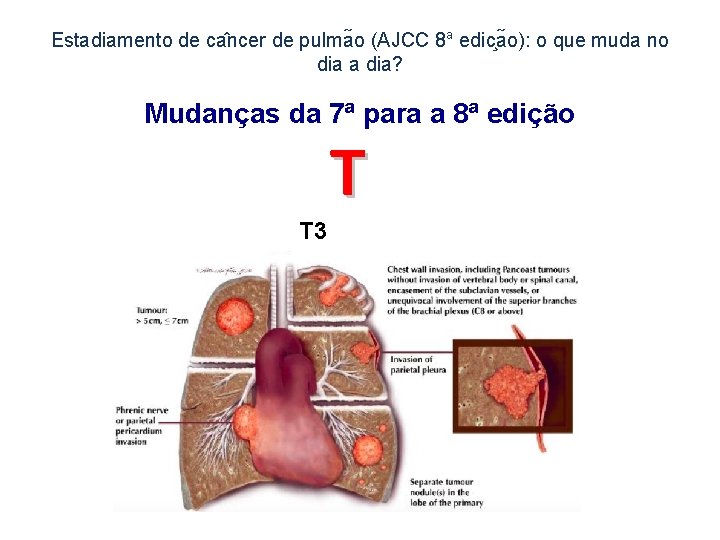 Estadiamento de ca ncer de pulma o (AJCC 8 a edic a o): o