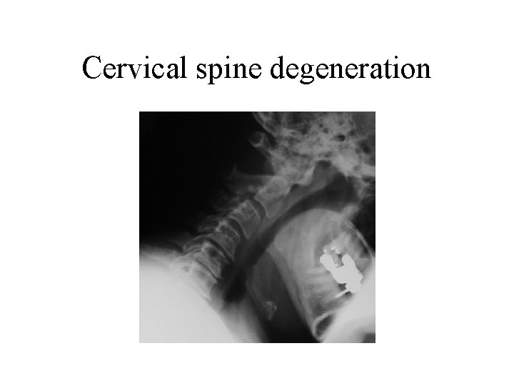 Cervical spine degeneration 
