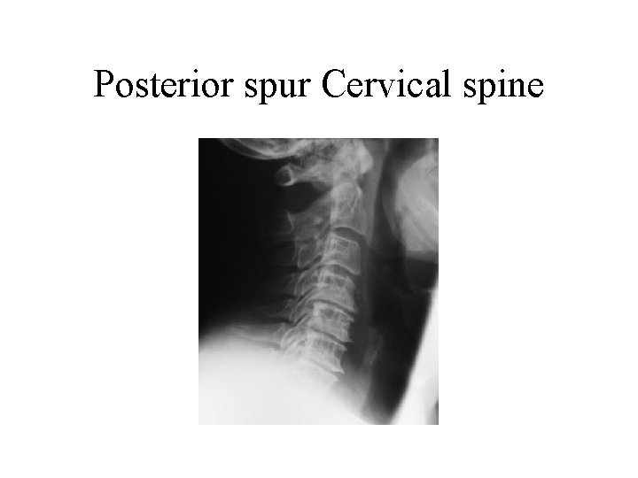 Posterior spur Cervical spine 