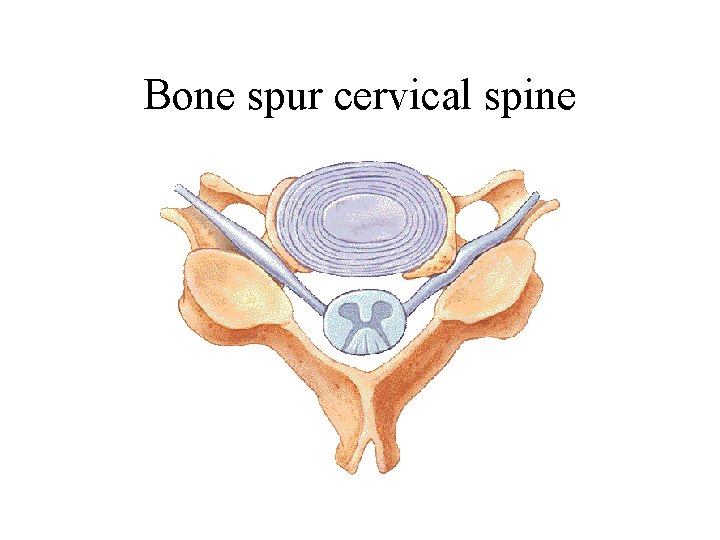 Bone spur cervical spine 