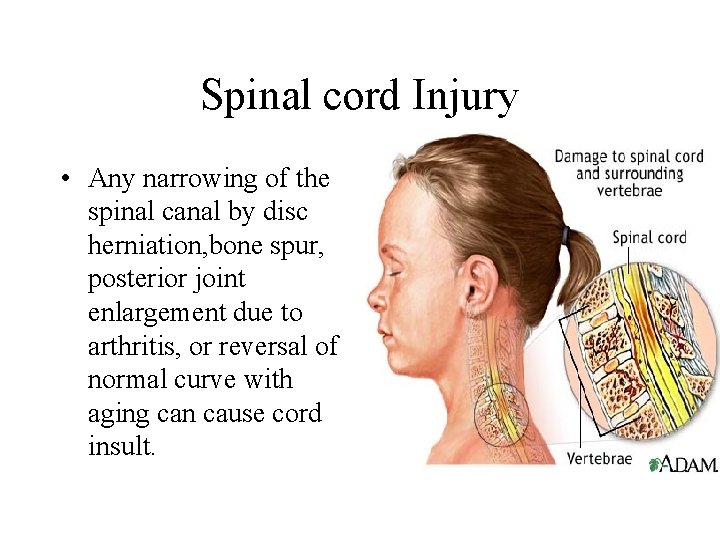 Spinal cord Injury • Any narrowing of the spinal canal by disc herniation, bone