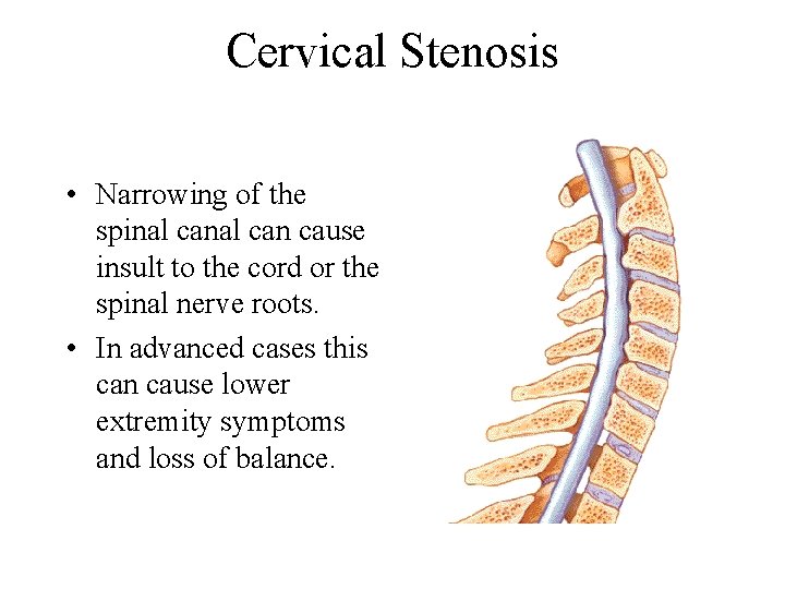Cervical Stenosis • Narrowing of the spinal can cause insult to the cord or
