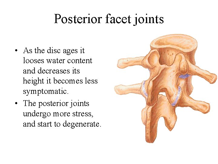 Posterior facet joints • As the disc ages it looses water content and decreases