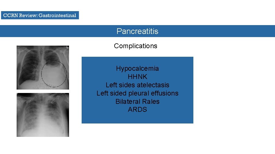 Pancreatitis Complications Hypocalcemia HHNK Left sides atelectasis Left sided pleural effusions Bilateral Rales ARDS